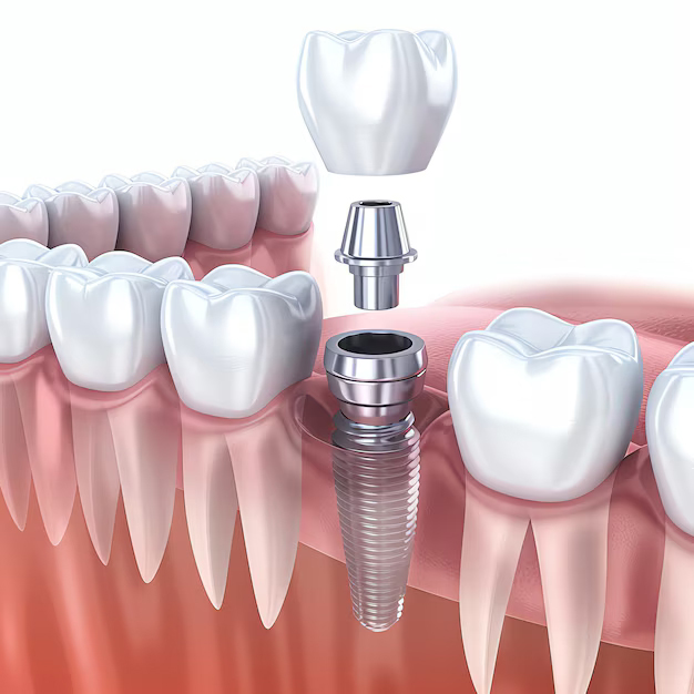 Close up of a dental tooth implant or healthy human teeth White enamel and dental implants surgery