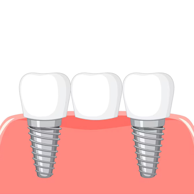 Implant Supported Bridge