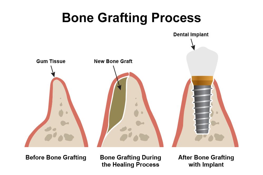 Understanding Bone Grafting for Dental Implants Process